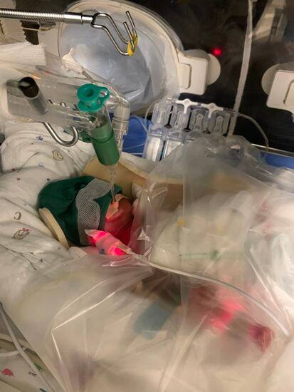 590g 몸무게인 초극소미숙아아로 태어난 유준이의 신생아중환자실 입원 첫 날 모습. /서울성모병원 제공