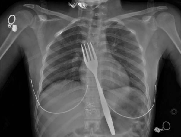뱃속에 포크가 들어있는 모습이 확인되는 엑스레이 사진./사진=큐레우스