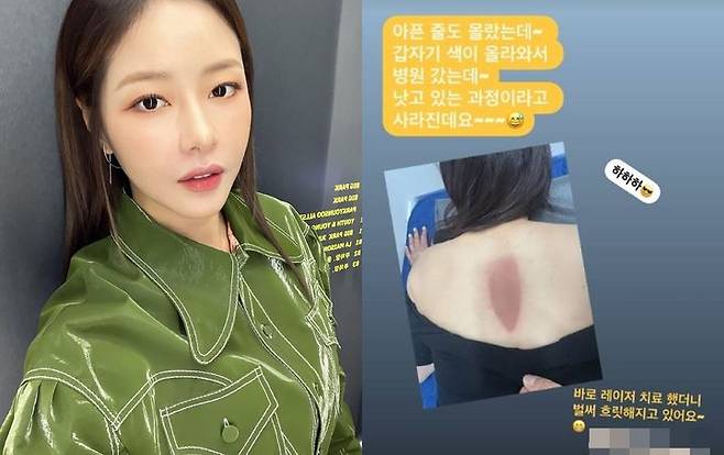 [서울=뉴시스] 박하나(왼쪽)·박하나가 올린 화상 입은 사진. (사진=인스타그램 캡처) 2025.04.30. photo@newsis.com *재판매 및 DB 금지