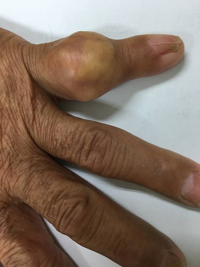 손가락에 통풍 결절이 생긴 환자 사례. 강병주 교수 제공