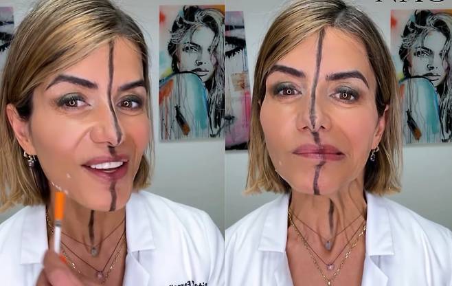 미국의 미용의학 전문의인 비타 패럴이 보톡스를 맞은 오른쪽 얼굴(화면상 왼쪽)과 맞지 않은 왼쪽 얼굴을 비교해 설명하고 있다. /인스타그램