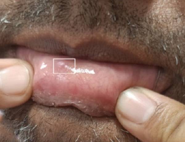 아랫입술에 생긴 작은 부종이 기생충 유충 때문이었다는 사례가 보고됐다./사진=구강악안면병리학 저널​
