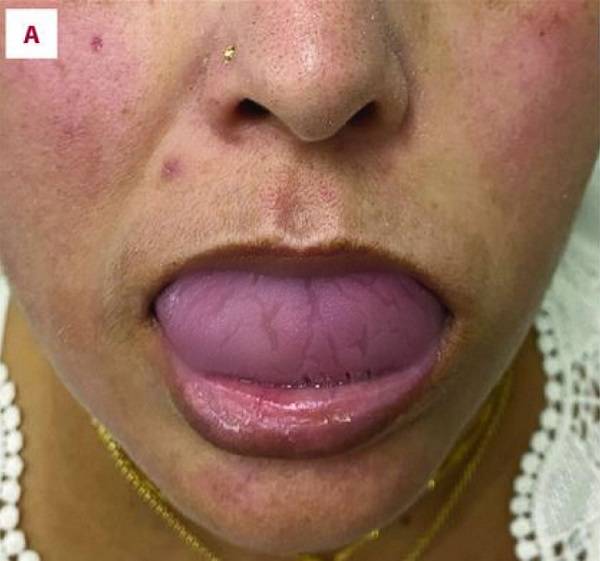 균열된 혀가 발생한 멜커슨 로젠탈 증후군 환자​. 블러 처리한 사진으로, 실제 환자의 혀는 더 깊게 갈라졌다./사진=American Journal of Case Reports