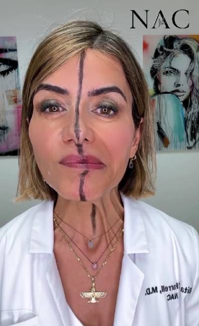 미국의 비타 패럴 박사가 보톡스를 맞은 오른쪽 얼굴(화면상 왼쪽)과 맞지 않은 왼쪽 얼굴을 비교해 설명하고 있다. [사진=비타 패럴 인스타그램 캡쳐]