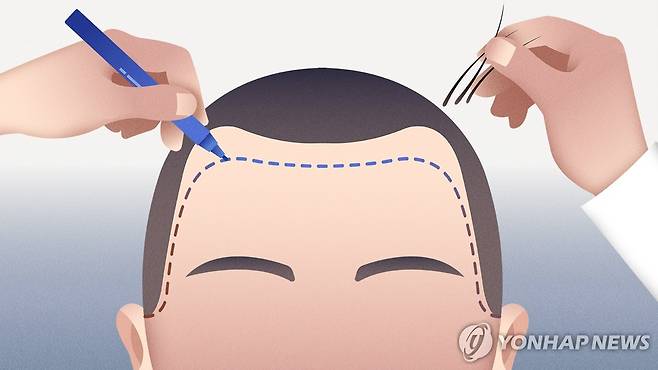 남성 모발이식 (PG) [강민지 제작] 일러스트
