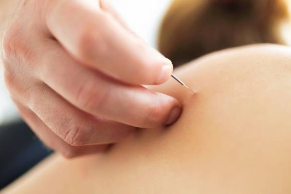 침술 자료 이미지. 123rf