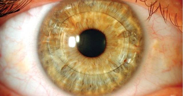 사진은 각막과 홍채 사이에 알티플러스 렌즈를 삽입한 모습. 눈시원안과의원 제공