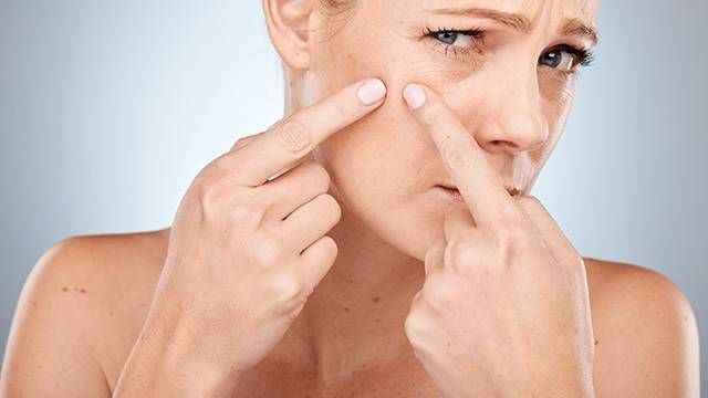 피지낭종이 생기면 짜고 싶은 충동이 들 수 있지만, 피부 건강을 위해 참아야 한다｜출처: 게티이미지뱅크