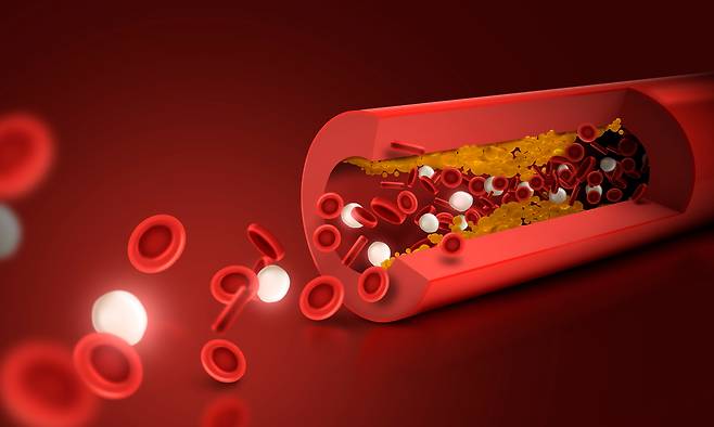많은 사람이 나쁜 콜레스테롤 수치가 높으면 심혈관 질환에 걸리기 쉽다고 생각하지만 이 수치가 낮아도 죽상동맥경화증을 앓는 사람이 있다.  이  지표보다는   ApoB-P(아포지단백 B 함유 입자)가 관상동맥 질환을 정확히 예측하는 것으로 나타났다.  [사진=클립아트코리아]