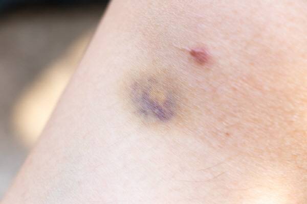 잦은 멍은 노화의 원인이 크지만, 때론 특정 약물이나 질환이 원인일 수 있다./사진=게티이미지뱅크