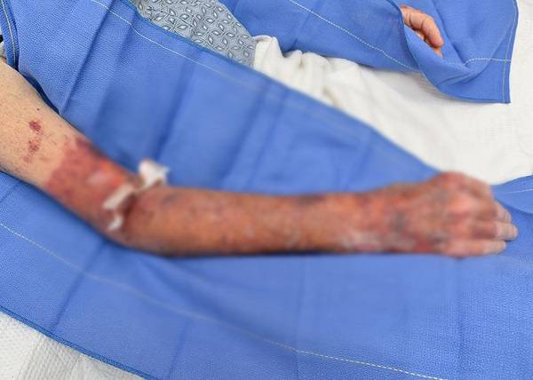 알코올에 중독됐다가 팔의 살가죽이 전부 벗겨진 미국 50대 남성 사진​/사진=Journal of Investigative Medicine High Impact Case Reports