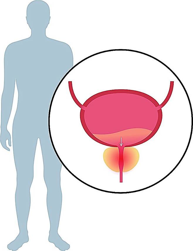 전립선비대증 치료법인 리줌은 최소 침습적 방법으로 출혈과 상처가 거의 없고 시술 후 일상으로의 복귀가 빠르다. 게티이미지코리아