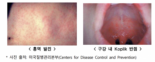 홍역 확진자에게 나타날 수 있는 발진과 반점 증상. 질병관리청 제공