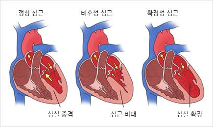 심근병증은 다양한 유형으로 나타나며 크게 분류해 심장근육이 두꺼워지는 비후성 심근과 심실이 확장돼 늘어지는 확장성 심근으로 나뉜다. 서울아산병원 제공