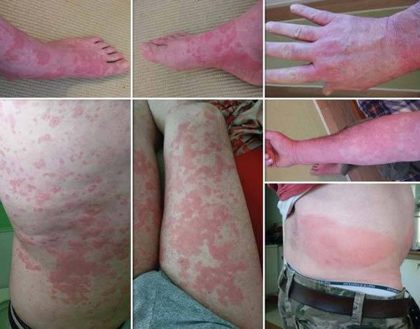 온몸에 두드러기가 생긴 슈니츨러 증후군 환자 사진/사진=Auto-Inflammatory Syndromes