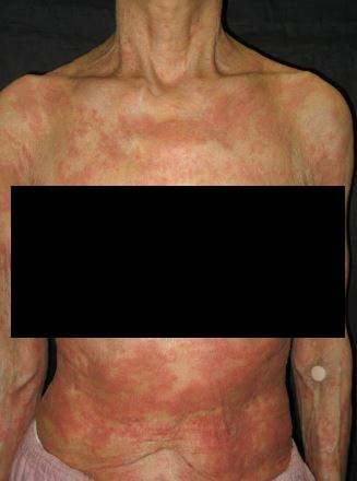 두드러기가 발생한 슈니츨러 증후군 환자 사진/사진=Dermatology Advisor