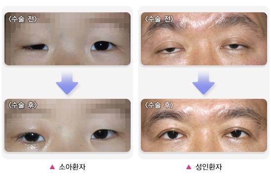 안검하수가 생겼다면 수술로 위아래 눈꺼풀 사이 간격을 넓힐 수 있다. 국가건강정보포털