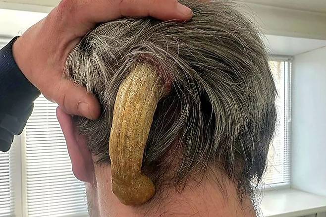 러시아 30대 남성이 3년 전부터 뒤통수에 자라난 13㎝ 길이 뿔을 제거하는 수술을 받았다. /사진=영국 미러 홈페이지 갈무리