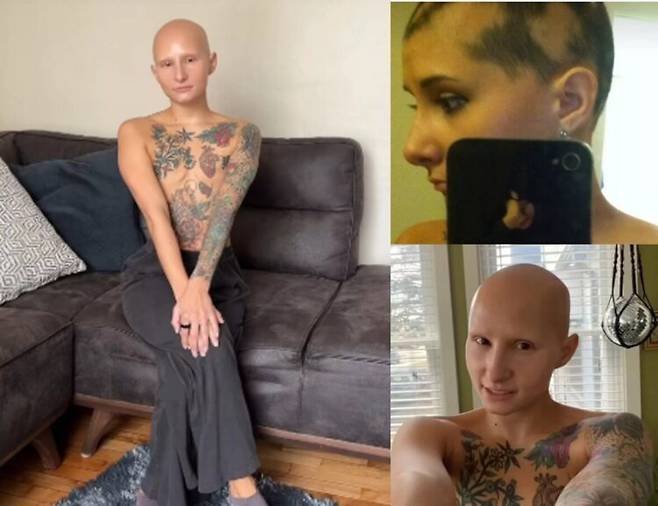 9살때 부터 탈모증이 시작돼 10대때 머리카락이 거의 빠져가 대머리로 살고 있는 여성이, 유방암을 미리 예방하기 위해 양쪽 가슴까지 잘라낸 사연을 전했다. [사진=SNS]