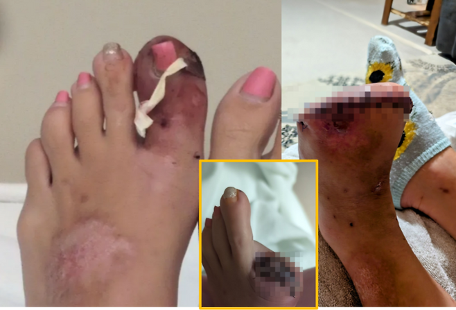 발톱이 살 안쪽을 파고드는 내향성 발톱을 방치했다가 발가락 전부를 절단해야 하는 여성의 사연이 전해졌다. [사진=SNS]