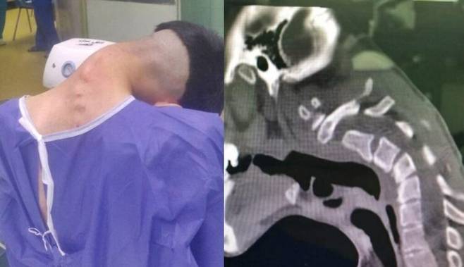 수년 간의 약물 남용으로 인해 목이 가슴에 닿을 정도로 경추가 변형된 사례가 보고됐다. [사진=Clinical Case Reports]