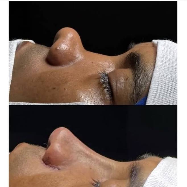 5FE4500D-9AA2-4ABF-A8D9-907B481FBDB7.jpeg 레전드 코 성형수술. jpg