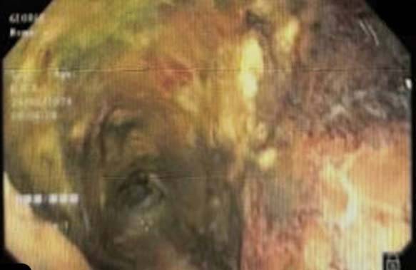 전자담배를 피운 뒤 식도에 광범위한 궤양성 병변, 괴사가 발생해 까맣게 변한 모습./사진=큐레유스