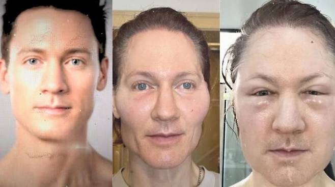 [서울=뉴시스] 피부 노화를 막기 위해 매 년 200만 달러를 사용하는 것으로 알려진 브라이언 존슨은 레누바 시술 이후 부작용을 겪었다.(사진=비즈니스 투데이 캡쳐) 2025.05.12 *재판매 및 DB 금지