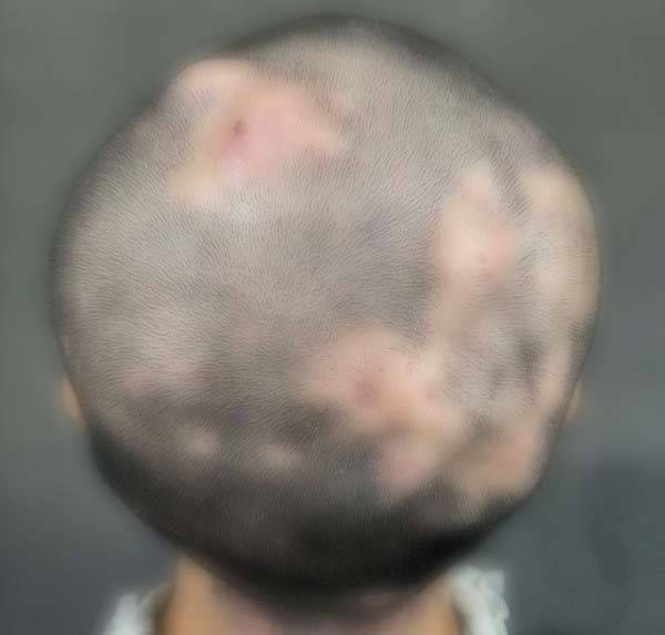 두피 모낭염으로 인해 탈모가 발생한 20대 남성 A씨의 모습./사진=성형외과 및 재건외과 글로벌 오픈