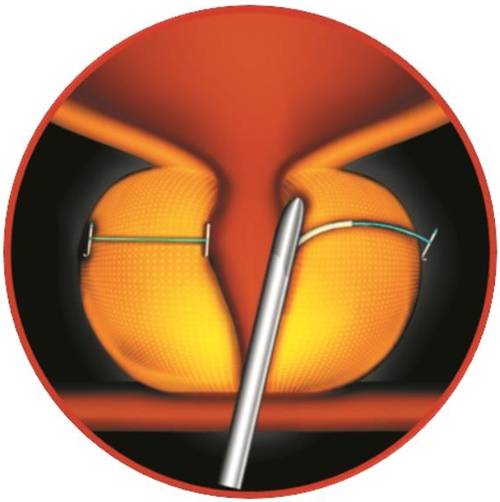 유로리프트 시술로 압박된 소변 통로를 열어준 모습.