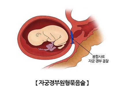 자궁경부봉합술​./사진=서울아산병원