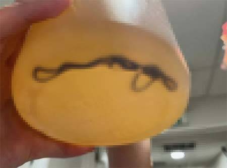 소변에서 발견된 검은색 기다란 물체. 의료진은 처음에 기생충을 의심했으나 혈전(피떡)인 것으로 확인됐다./사진=BMC-Part of Springer Nature