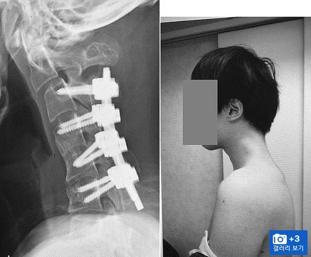 휴대폰을 너무 많이 보면서 발생한 25세 게이머 '머리 떨어뜨림 증후군' 이미지. 의료진은 그의 목 부위 자세를 교정하기 위해 목뼈에 일련의 나사와 금속 막대를 삽입했다(왼쪽 사진). 오른쪽 사진은 시술 후 6개월 후의 모습. [데일리메일 캡처]