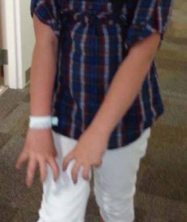 돌발성 운동유발 이상운동증 때문에 손가락이 뒤틀린 모습/사진=Pediatric Neurology