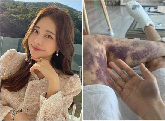 SNS에 멍 든 사진을 공개한 아옳이. [아옳이 인스타그램 캡처]