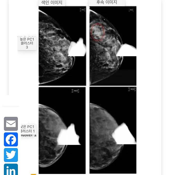 IMG_6497.jpeg 유방 질감패턴으로 유방암 식별하는 새로운 이론 근황