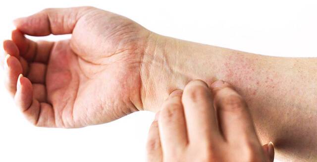 옴진드기는 0.3~0.4㎜ 정도밖에 안 되지만 엄청난 가려움증을 유발하는 게 특징이다.  게티이미지뱅크