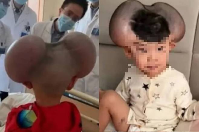 희귀질환을 앓던 중국의 치바오. /웨이보