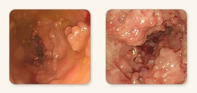 곳곳에 염증이 발생한 크론병 환자의 대장내시경 사진｜출처: 질병관리청