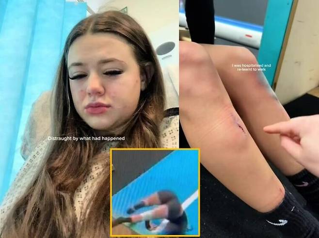 치어리딩 동작을 하다 심각한 부상을 입은 여성의 사연이 소개됐다. 의사는 그의 부상을 '자동차 충돌' 사고에 비유했다. [사진=SNS]