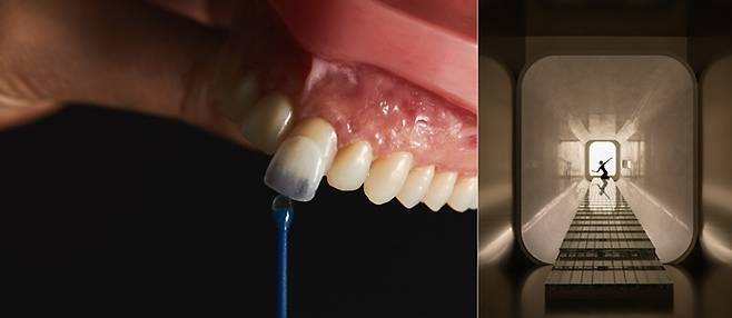 최근 연예인, 인플루언서는 물론 해외에서도 입소문을 탄 K-심미치료 ‘제로네이트’를 시술받기 위해 한국을 방문하는 관광객들이 증가하고 있다. 사진 | 티유치과 SNS