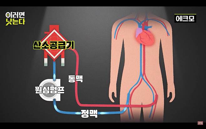 에크모 그림(ECMO)