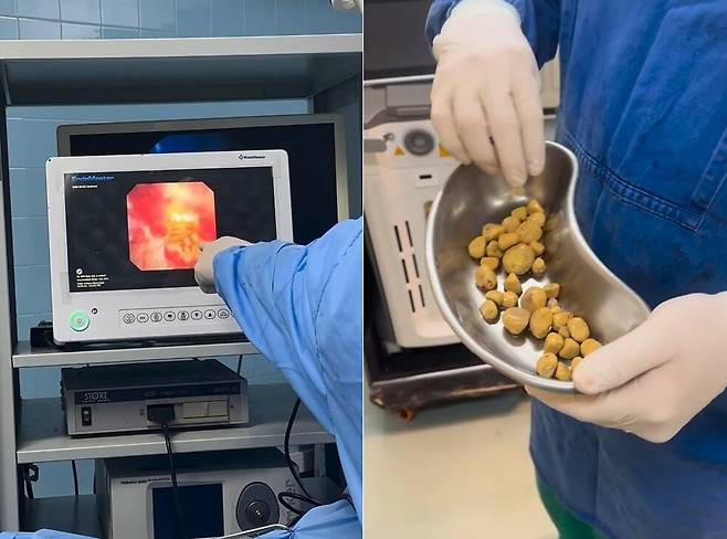 A씨 몸에서 나온 결석들. /인스타그램