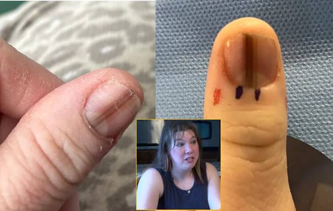 손톱에 생긴 갈색 선을 처음엔 영양 결핍으로 여겼으나 이후 희귀 피부암 진단을 받은 여성의 사연이 전해졌다. [사진=SNS]
