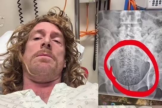 호주의 한 코미디언이 생 원두를 삼켰다가 장폐색으로 수술을 받았다. 사진=인스타그램(마이클앤아티)