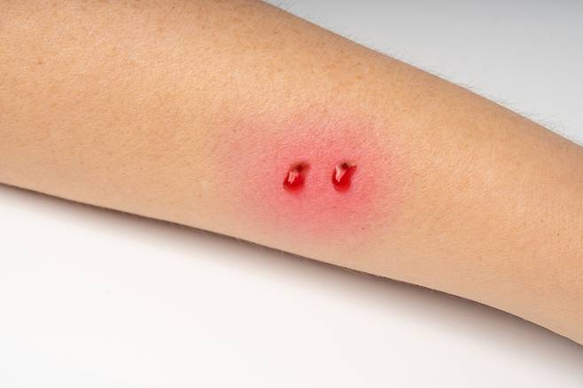 뱀 이빨에 사람 팔이 물린 자국.