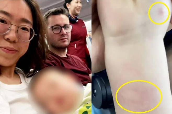 생후 12개월 아기의 다리에 난 벌레 물림 자국 때문에 비행기 탑승이 거부된 가족. 출처=뉴욕포스트