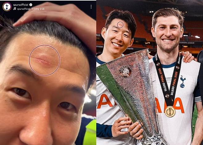 토트넘의 주장 손흥민이 머리카락을 들어올리며 이마에 난 상처를 보여주는 모습. 인스타그램 캡처