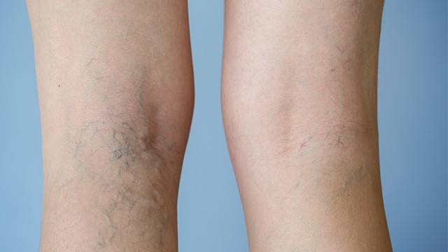 하지정맥류는 다리 정맥이 돌출되는 질환이다｜출처: 게티이미지뱅크