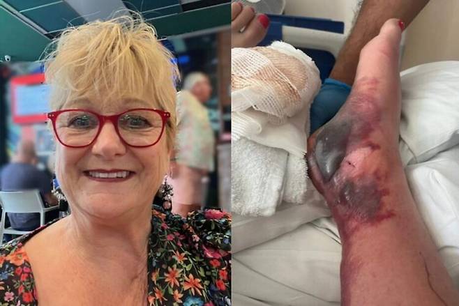 작은 유리 파편에 베인 상처가 생명을 위협하는 감염으로 이어진 경험을 한 여성의 사연이 소개됐다. [사진=SNS]